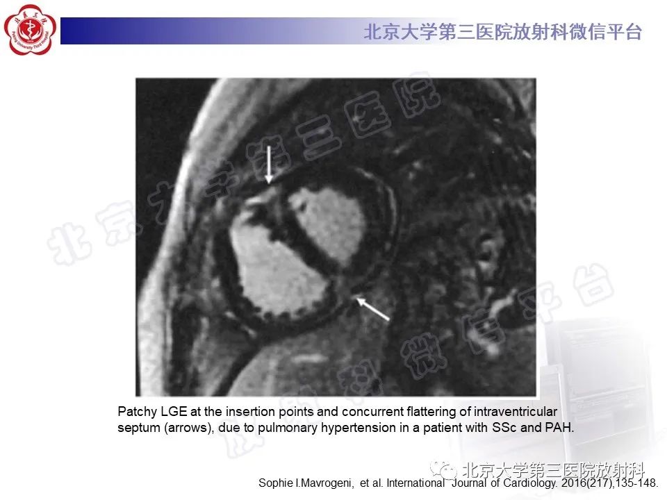 影像PPT - 【PPT】系统性硬化病心脏受累相关表现-31