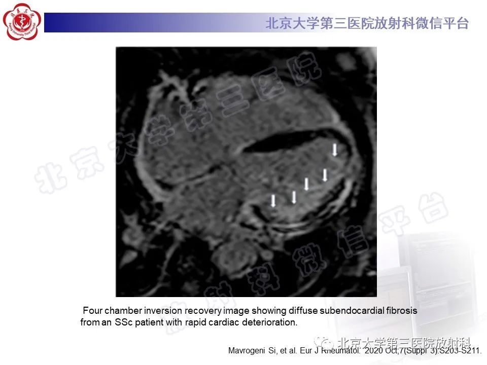 影像PPT - 【PPT】系统性硬化病心脏受累相关表现-32
