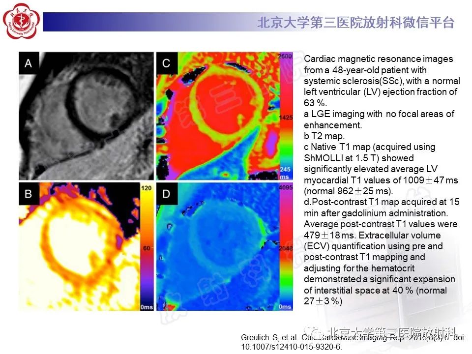 影像PPT - 【PPT】系统性硬化病心脏受累相关表现-33