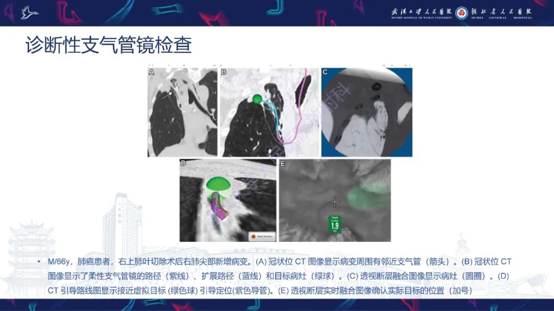 影像PPT - 【PPT】介入呼吸病学：放射科医师需要了解的知识-7