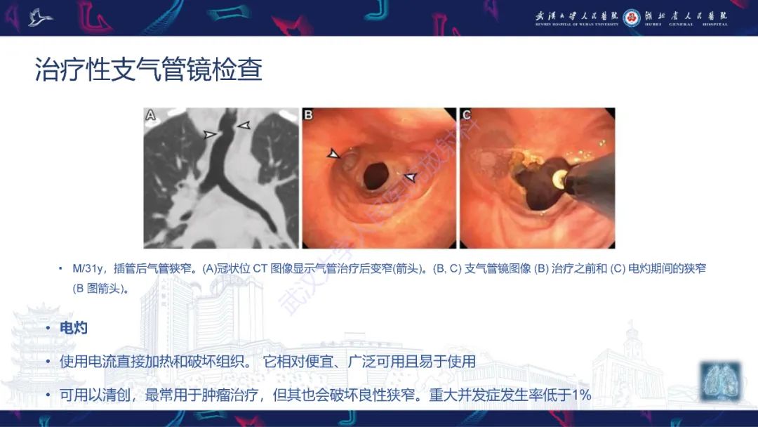 影像PPT - 【PPT】介入呼吸病学：放射科医师需要了解的知识-9