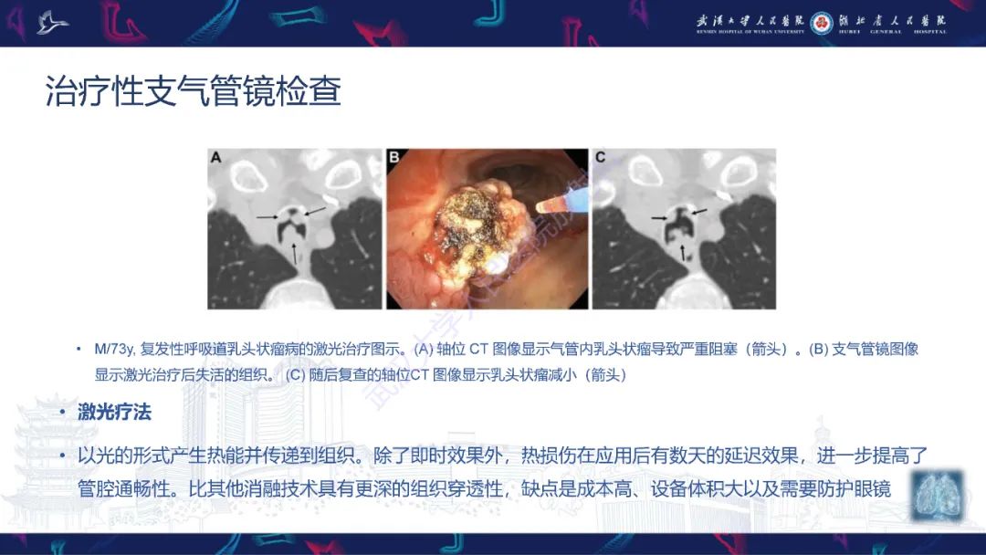 影像PPT - 【PPT】介入呼吸病学：放射科医师需要了解的知识-10