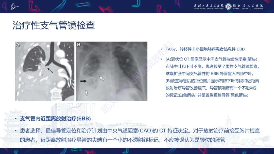 影像PPT - 【PPT】介入呼吸病学：放射科医师需要了解的知识-13