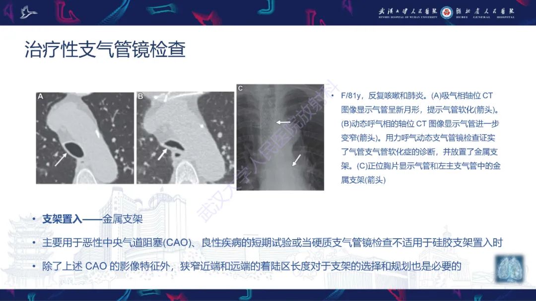 影像PPT - 【PPT】介入呼吸病学：放射科医师需要了解的知识-15
