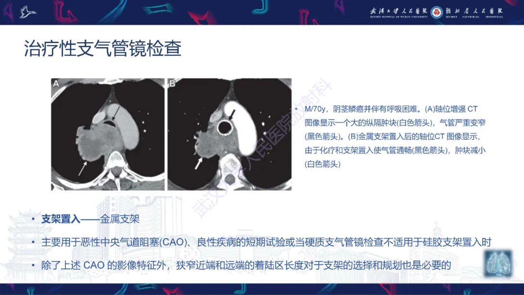 影像PPT - 【PPT】介入呼吸病学：放射科医师需要了解的知识-16
