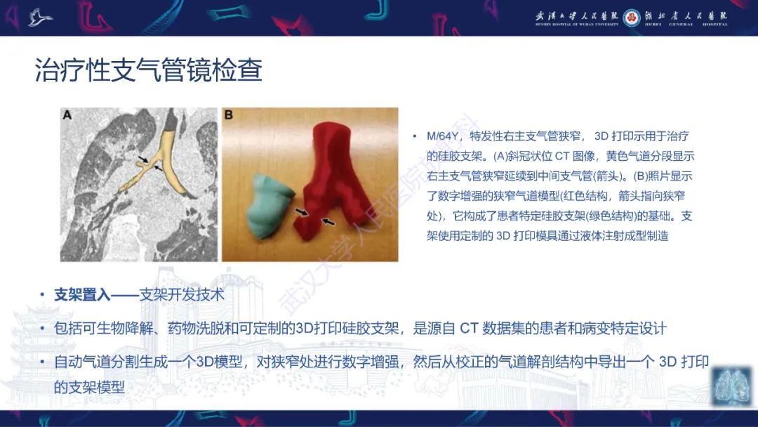影像PPT - 【PPT】介入呼吸病学：放射科医师需要了解的知识-18