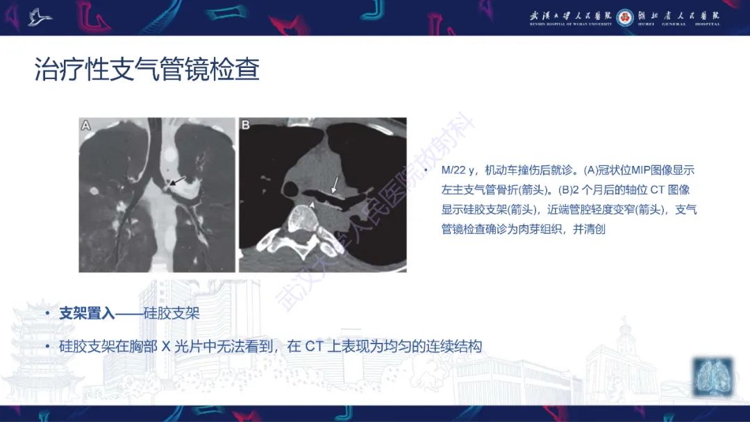 影像PPT - 【PPT】介入呼吸病学：放射科医师需要了解的知识-17