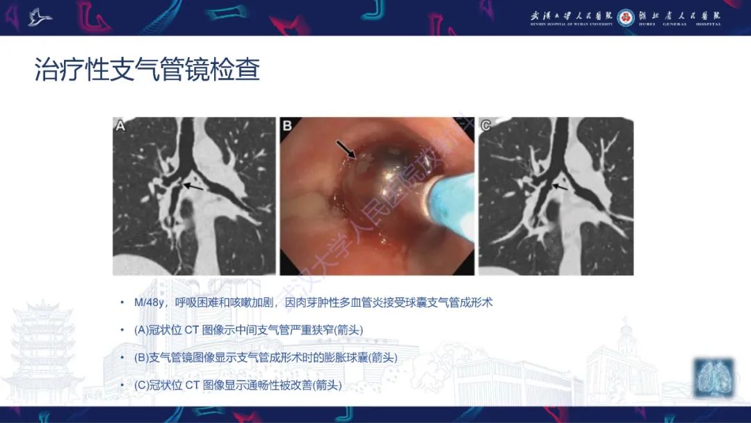 影像PPT - 【PPT】介入呼吸病学：放射科医师需要了解的知识-20
