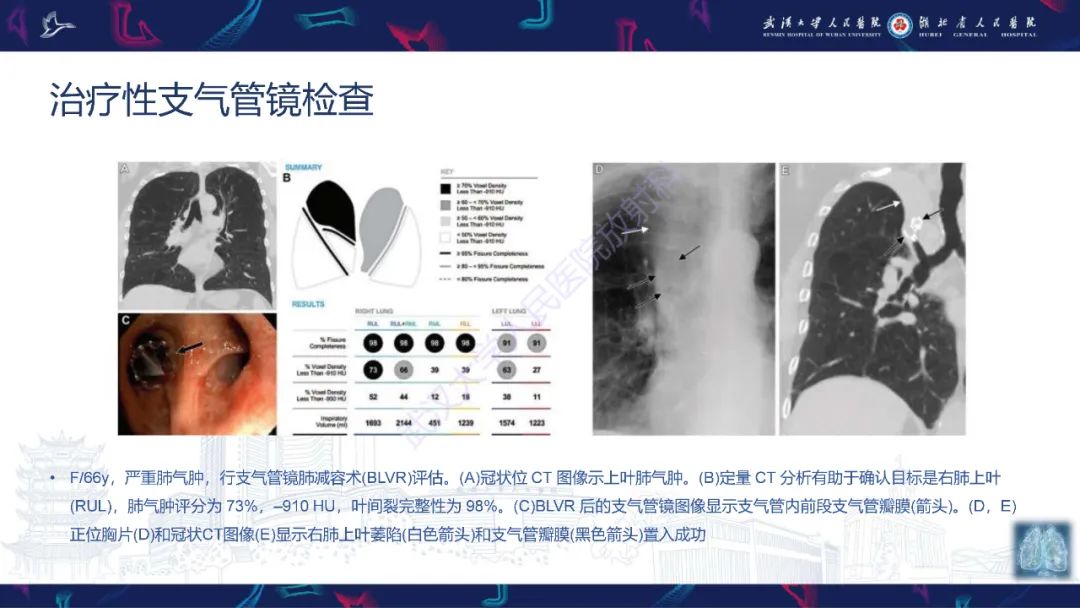 影像PPT - 【PPT】介入呼吸病学：放射科医师需要了解的知识-23
