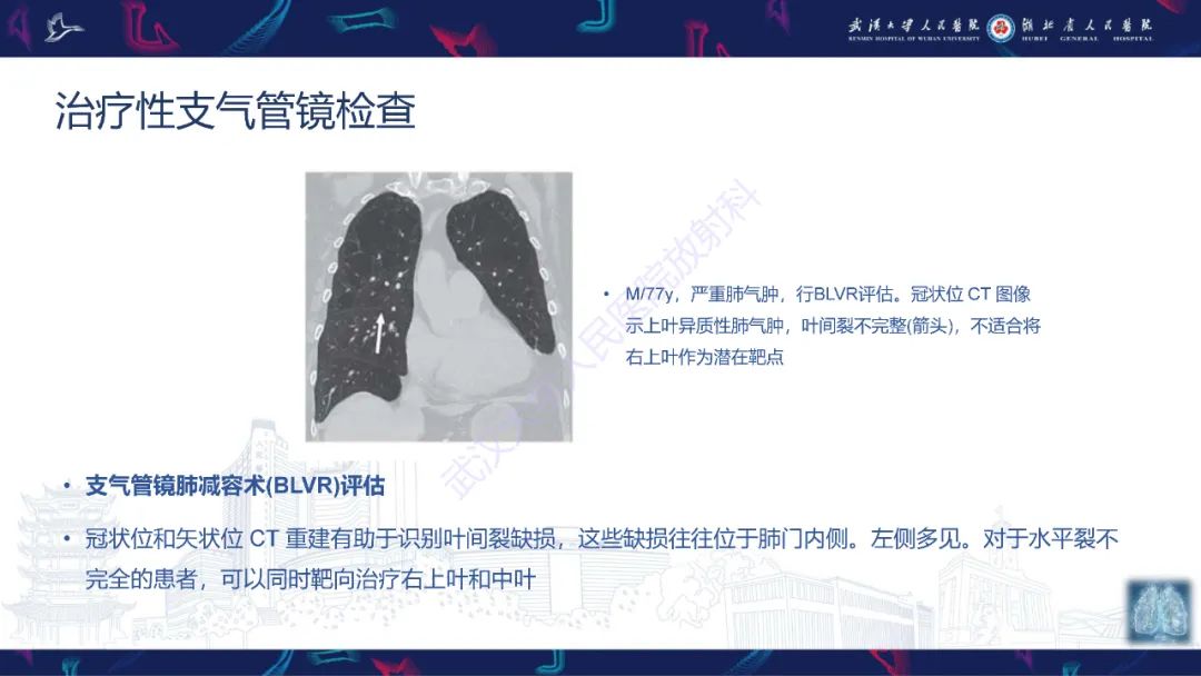 影像PPT - 【PPT】介入呼吸病学：放射科医师需要了解的知识-24