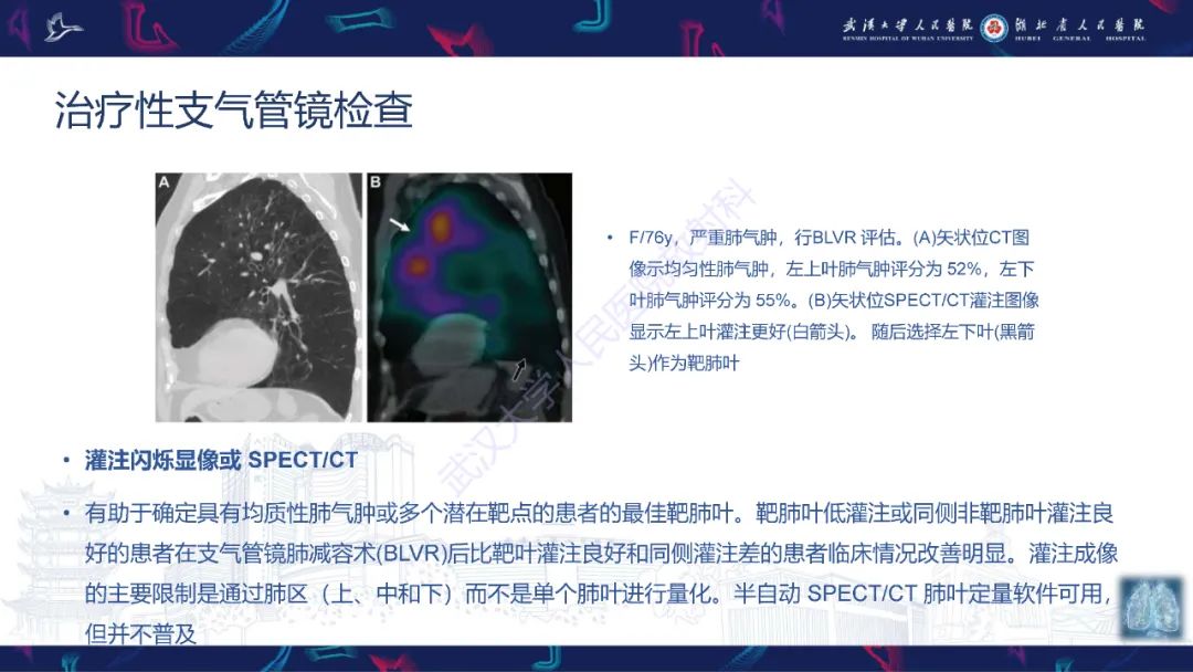 影像PPT - 【PPT】介入呼吸病学：放射科医师需要了解的知识-25