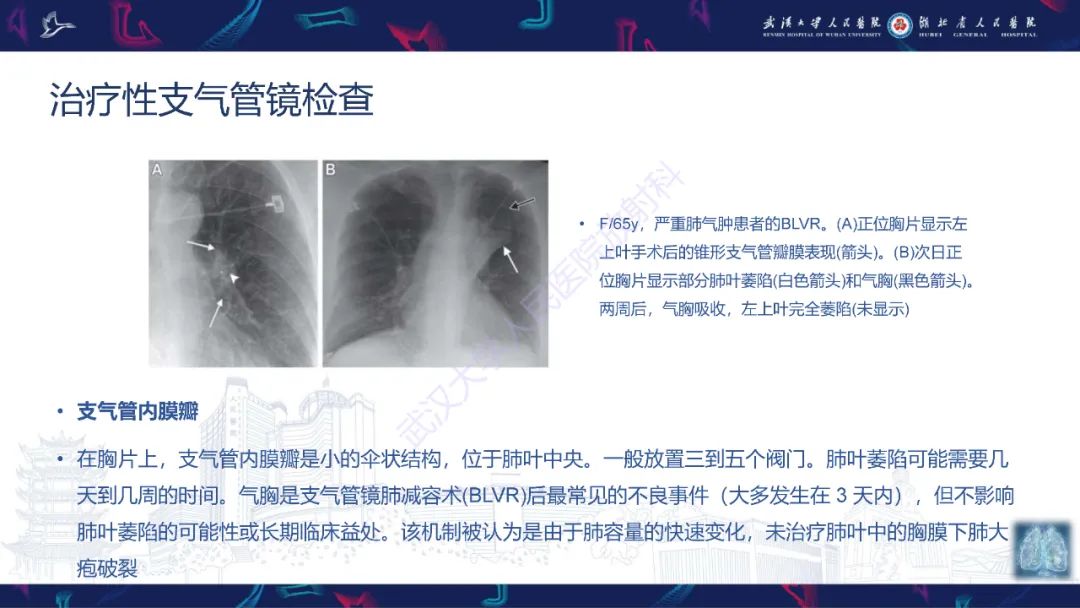 影像PPT - 【PPT】介入呼吸病学：放射科医师需要了解的知识-26
