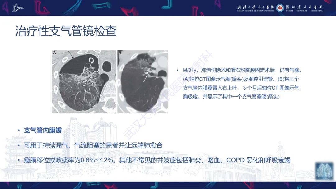 影像PPT - 【PPT】介入呼吸病学：放射科医师需要了解的知识-27