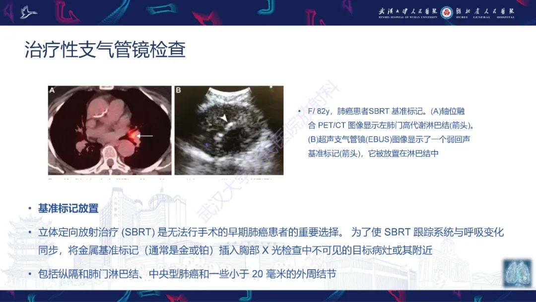 影像PPT - 【PPT】介入呼吸病学：放射科医师需要了解的知识-29