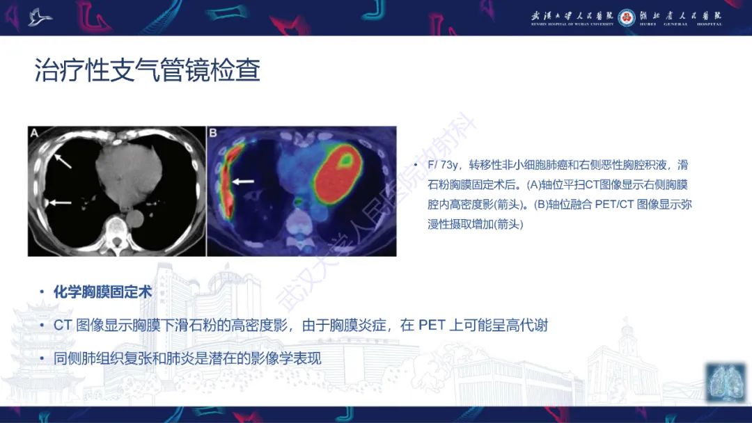 影像PPT - 【PPT】介入呼吸病学：放射科医师需要了解的知识-31