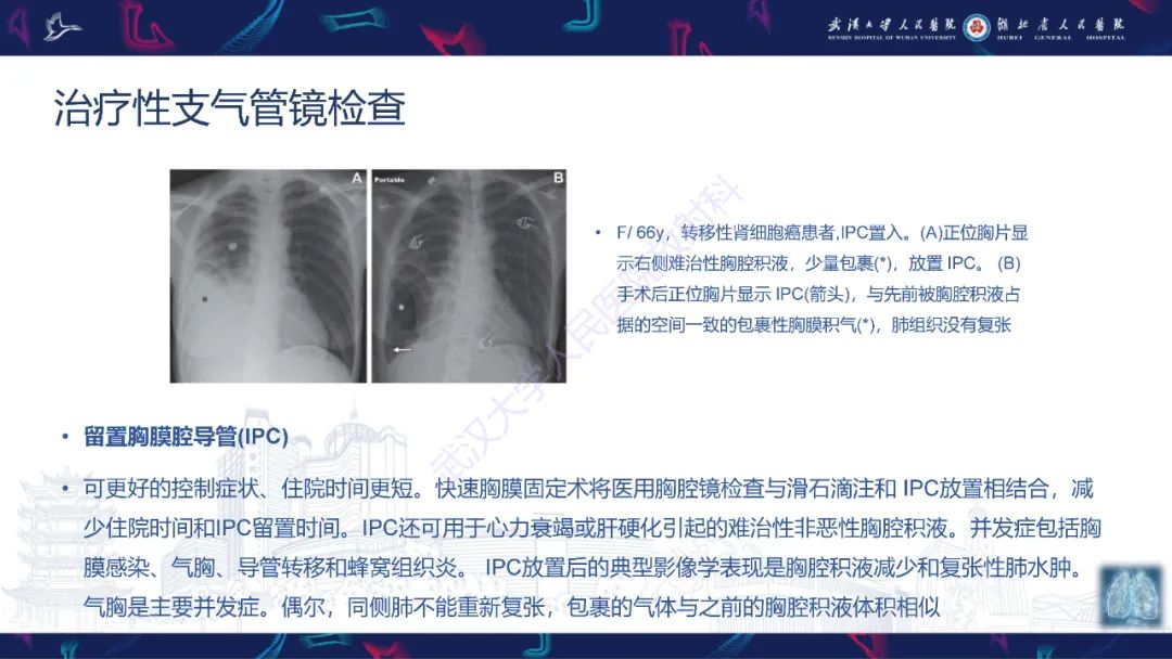 影像PPT - 【PPT】介入呼吸病学：放射科医师需要了解的知识-32