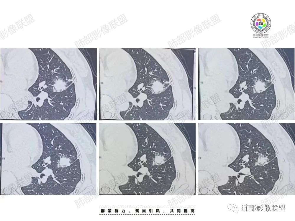 影像PPT - 【病例】中年女性的肺部富血供占位-3 影像PPT - 【病例】中年女性的肺部富血供占位-3