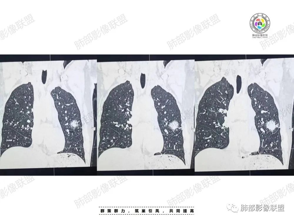 影像PPT - 【病例】中年女性的肺部富血供占位-8 影像PPT - 【病例】中年女性的肺部富血供占位-8