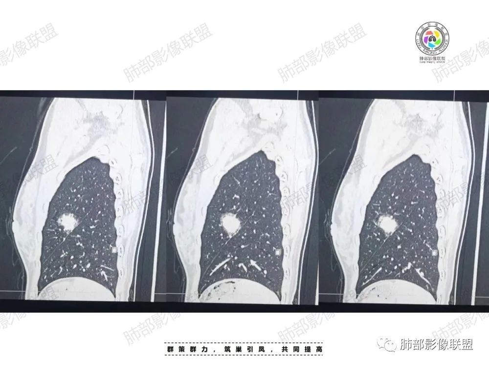 影像PPT - 【病例】中年女性的肺部富血供占位-10 影像PPT - 【病例】中年女性的肺部富血供占位-10