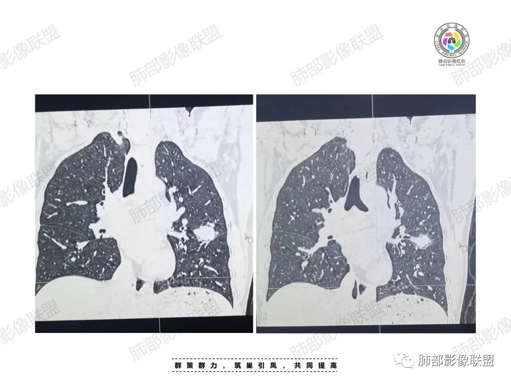 影像PPT - 【病例】中年女性的肺部富血供占位-12 影像PPT - 【病例】中年女性的肺部富血供占位-12
