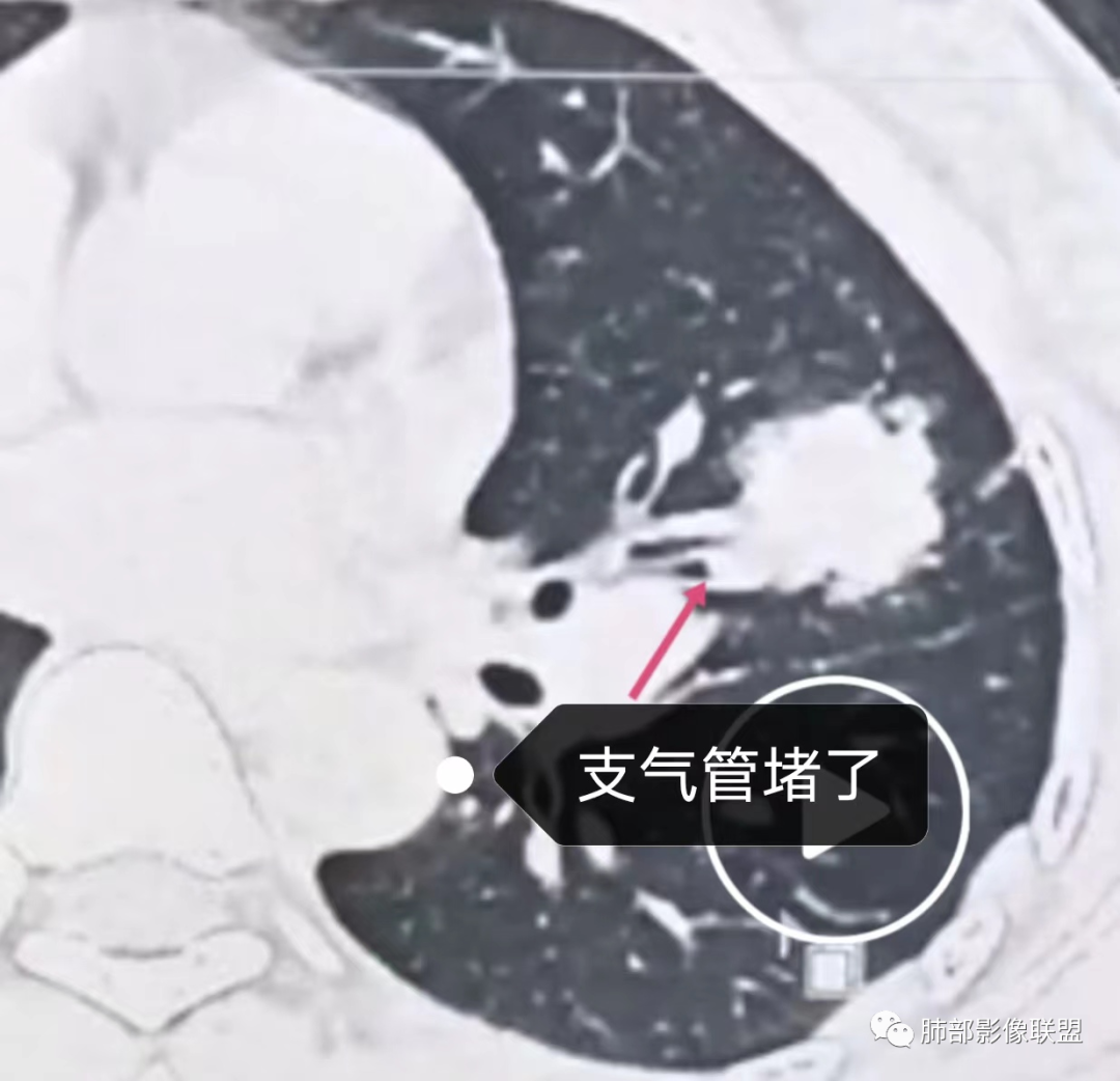 影像PPT - 【病例】中年女性的肺部富血供占位-19 影像PPT - 【病例】中年女性的肺部富血供占位-19