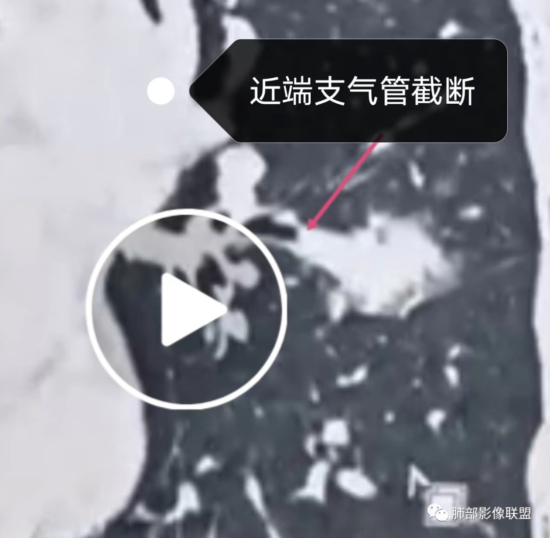 影像PPT - 【病例】中年女性的肺部富血供占位-20 影像PPT - 【病例】中年女性的肺部富血供占位-20