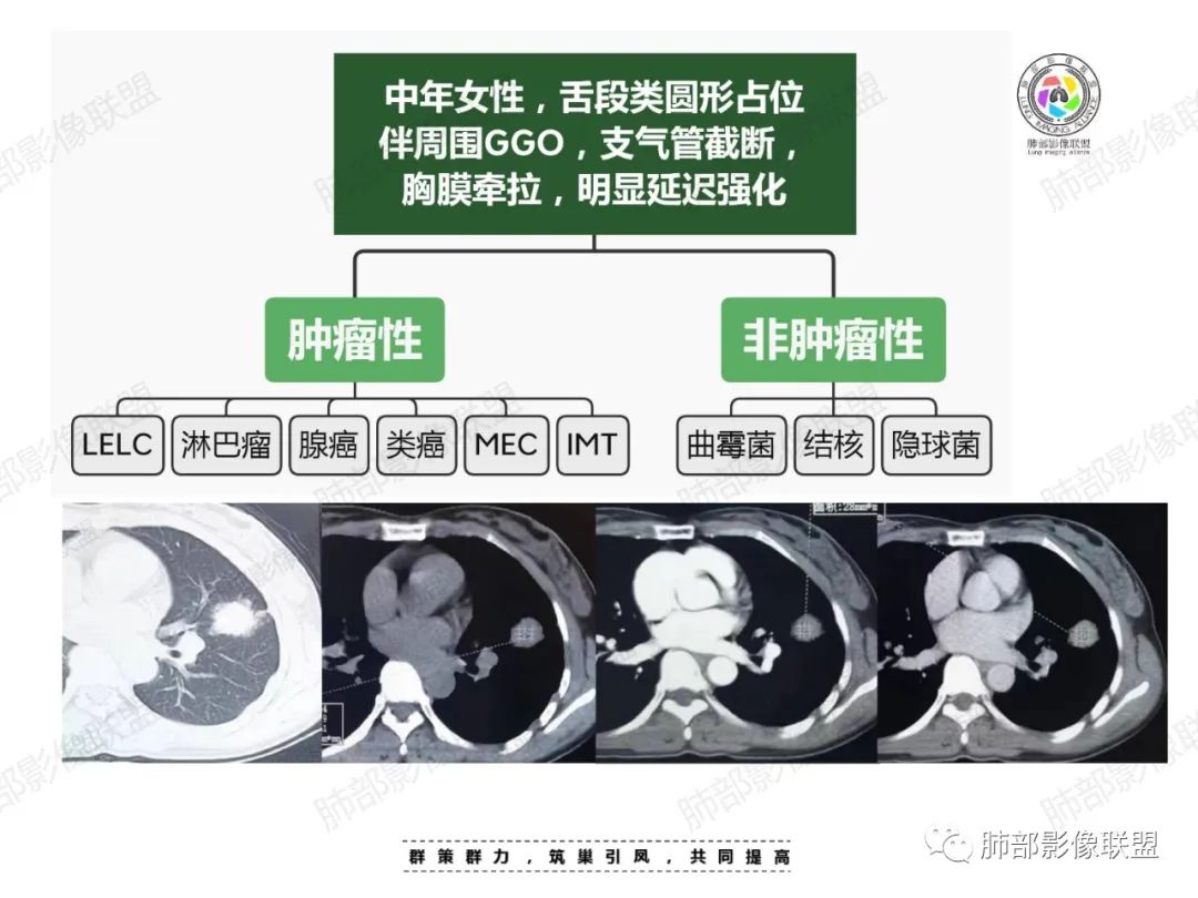 影像PPT - 【病例】中年女性的肺部富血供占位-23 影像PPT - 【病例】中年女性的肺部富血供占位-23