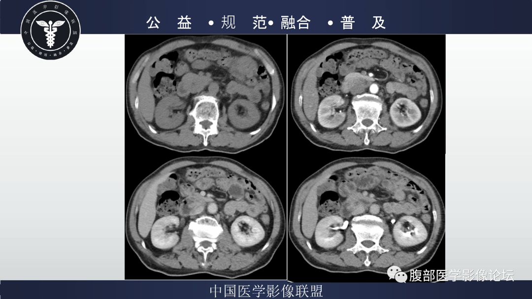 影像PPT - 【病例】巨细胞动脉炎累及肾脏1例CT影像-5
