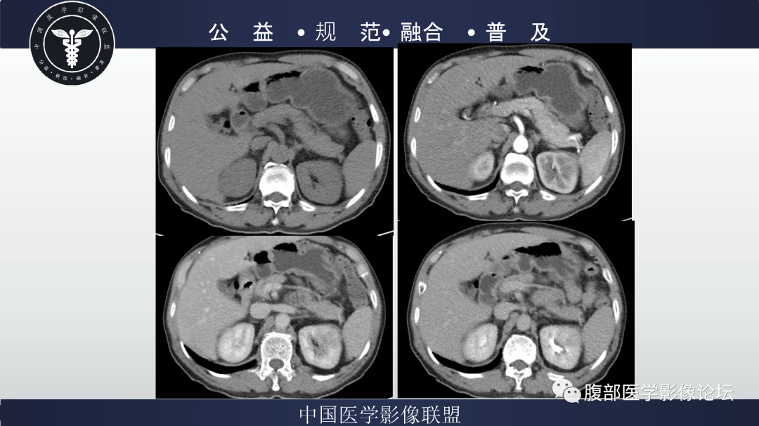 影像PPT - 【病例】巨细胞动脉炎累及肾脏1例CT影像-3