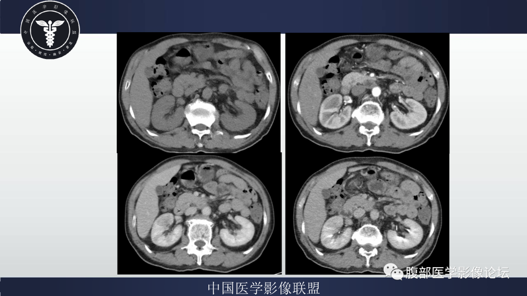 影像PPT - 【病例】巨细胞动脉炎累及肾脏1例CT影像-4