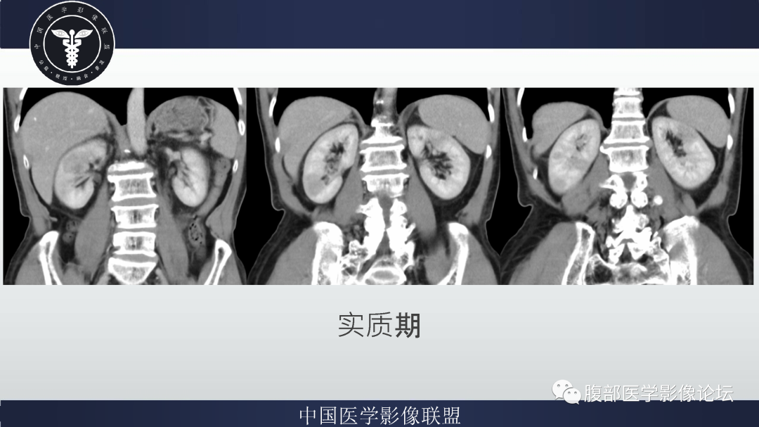 影像PPT - 【病例】巨细胞动脉炎累及肾脏1例CT影像-7