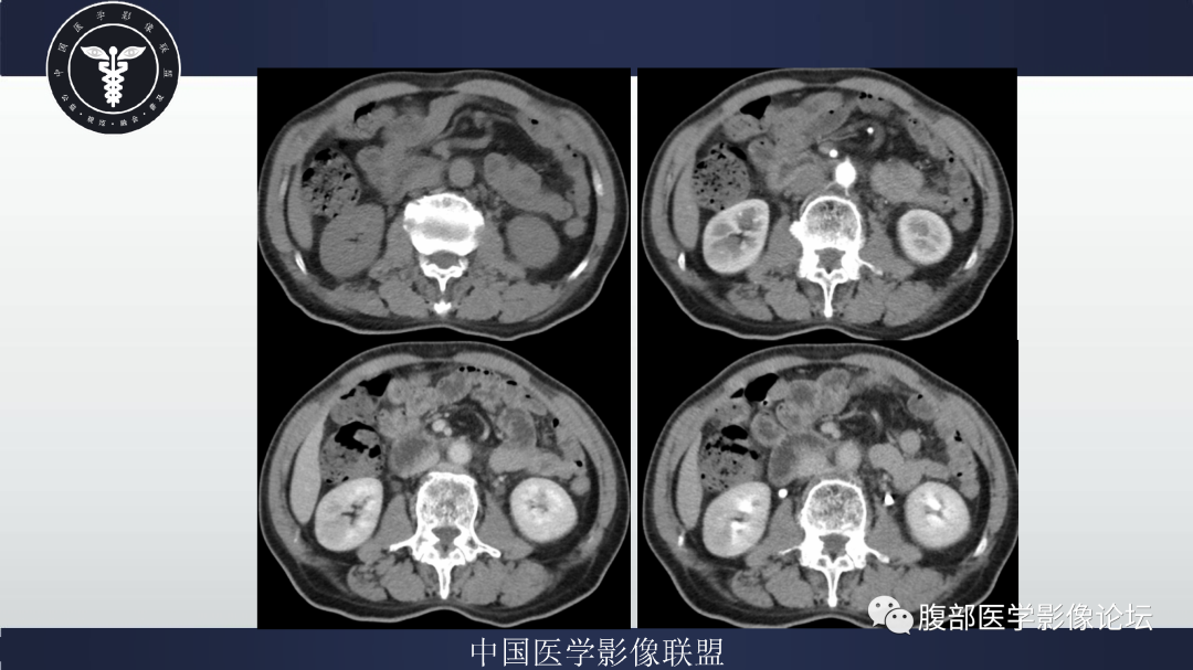 影像PPT - 【病例】巨细胞动脉炎累及肾脏1例CT影像-6