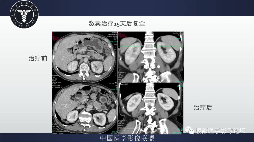 影像PPT - 【病例】巨细胞动脉炎累及肾脏1例CT影像-10