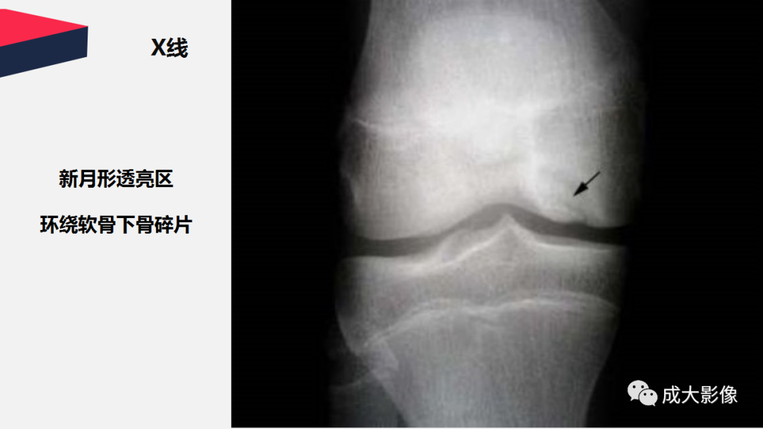 影像PPT - 【PPT】剥脱性骨软骨炎-11