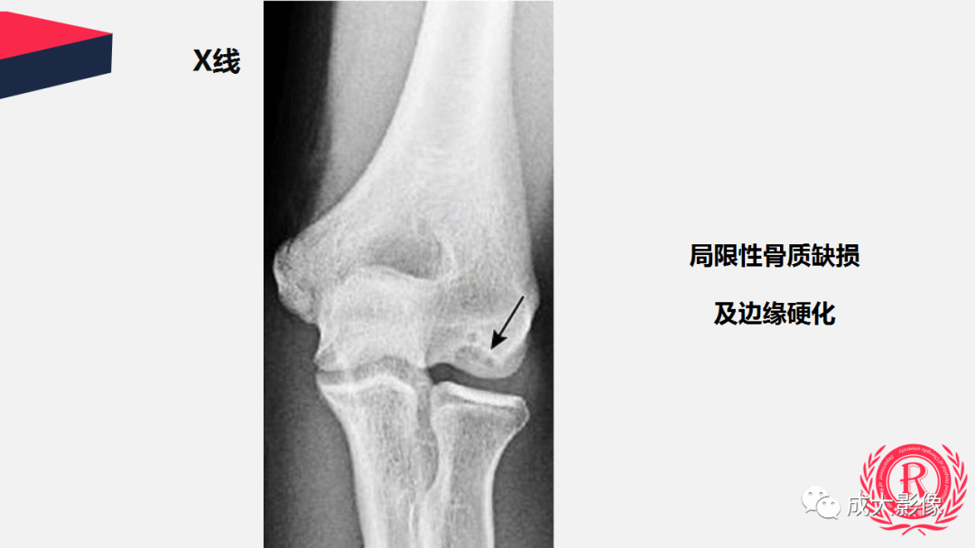 影像PPT - 【PPT】剥脱性骨软骨炎-13