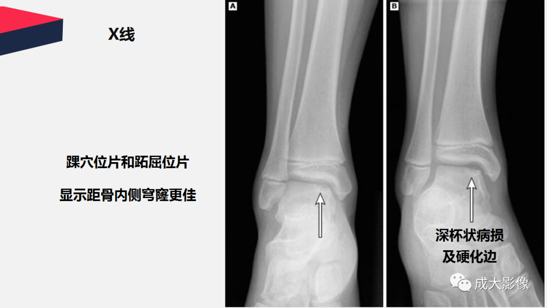影像PPT - 【PPT】剥脱性骨软骨炎-14