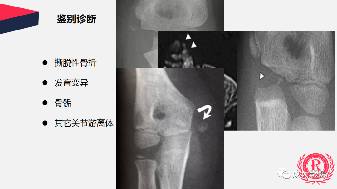 影像PPT - 【PPT】剥脱性骨软骨炎-25