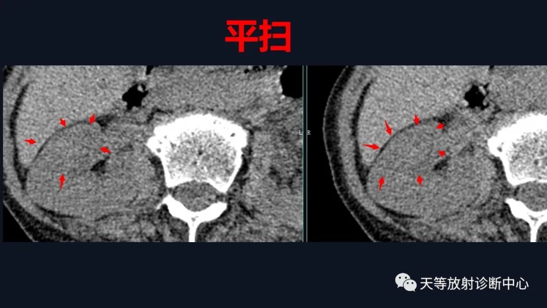 影像PPT - 【病例】肾血管平滑肌脂肪瘤1例CT影像-2 影像PPT - 【病例】肾血管平滑肌脂肪瘤1例CT影像-2