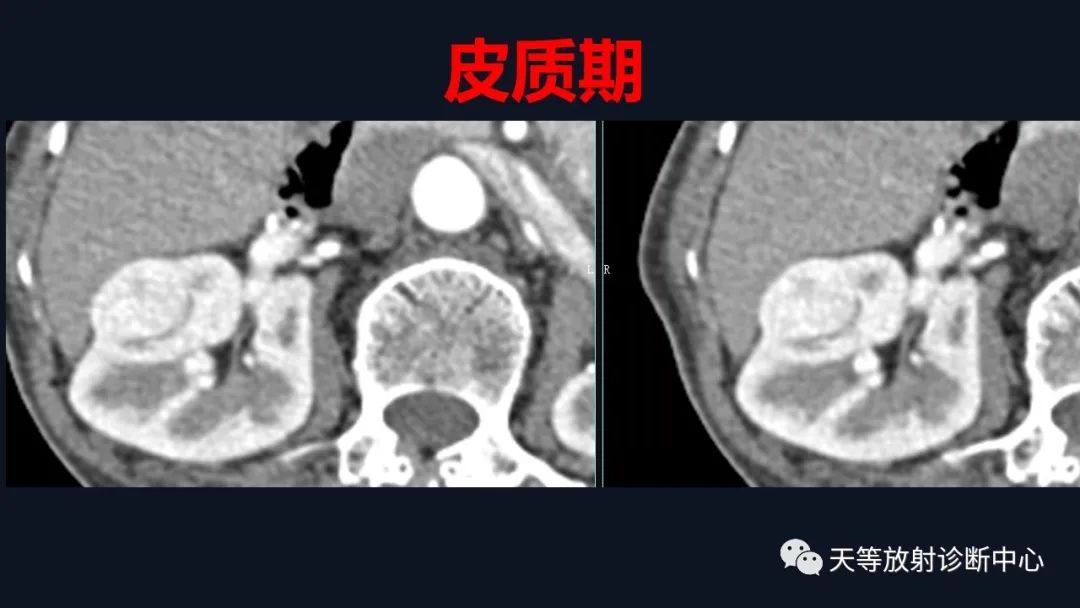 影像PPT - 【病例】肾血管平滑肌脂肪瘤1例CT影像-5 影像PPT - 【病例】肾血管平滑肌脂肪瘤1例CT影像-5