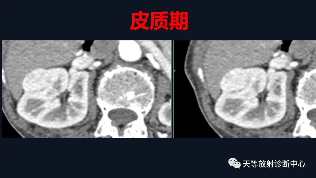 影像PPT - 【病例】肾血管平滑肌脂肪瘤1例CT影像-4 影像PPT - 【病例】肾血管平滑肌脂肪瘤1例CT影像-4