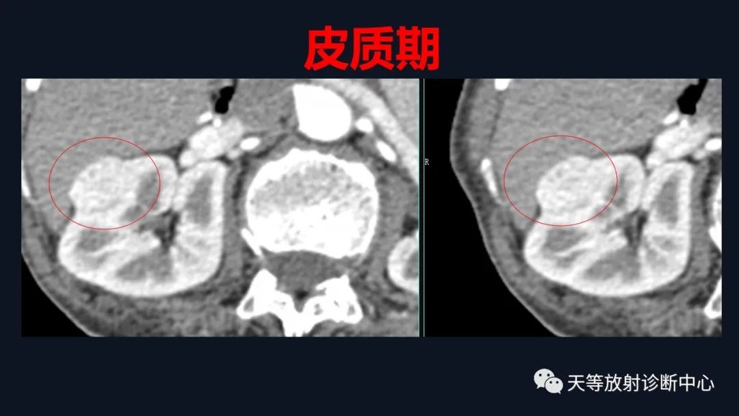 影像PPT - 【病例】肾血管平滑肌脂肪瘤1例CT影像-3 影像PPT - 【病例】肾血管平滑肌脂肪瘤1例CT影像-3
