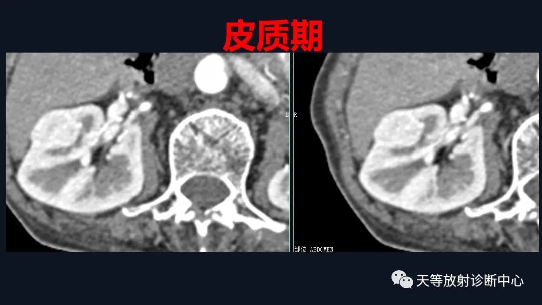 影像PPT - 【病例】肾血管平滑肌脂肪瘤1例CT影像-6 影像PPT - 【病例】肾血管平滑肌脂肪瘤1例CT影像-6