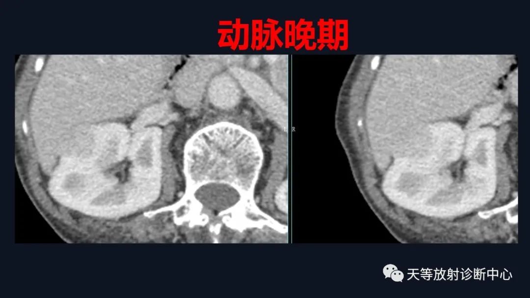 影像PPT - 【病例】肾血管平滑肌脂肪瘤1例CT影像-7 影像PPT - 【病例】肾血管平滑肌脂肪瘤1例CT影像-7