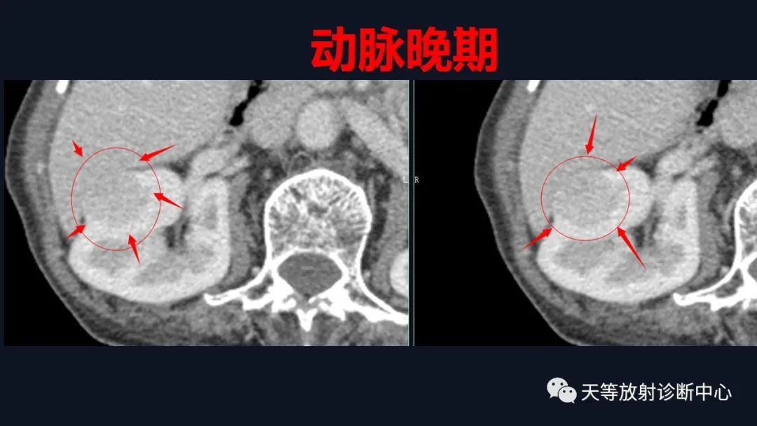 影像PPT - 【病例】肾血管平滑肌脂肪瘤1例CT影像-8 影像PPT - 【病例】肾血管平滑肌脂肪瘤1例CT影像-8