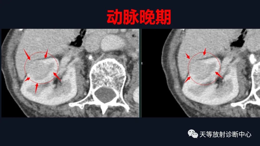 影像PPT - 【病例】肾血管平滑肌脂肪瘤1例CT影像-9 影像PPT - 【病例】肾血管平滑肌脂肪瘤1例CT影像-9