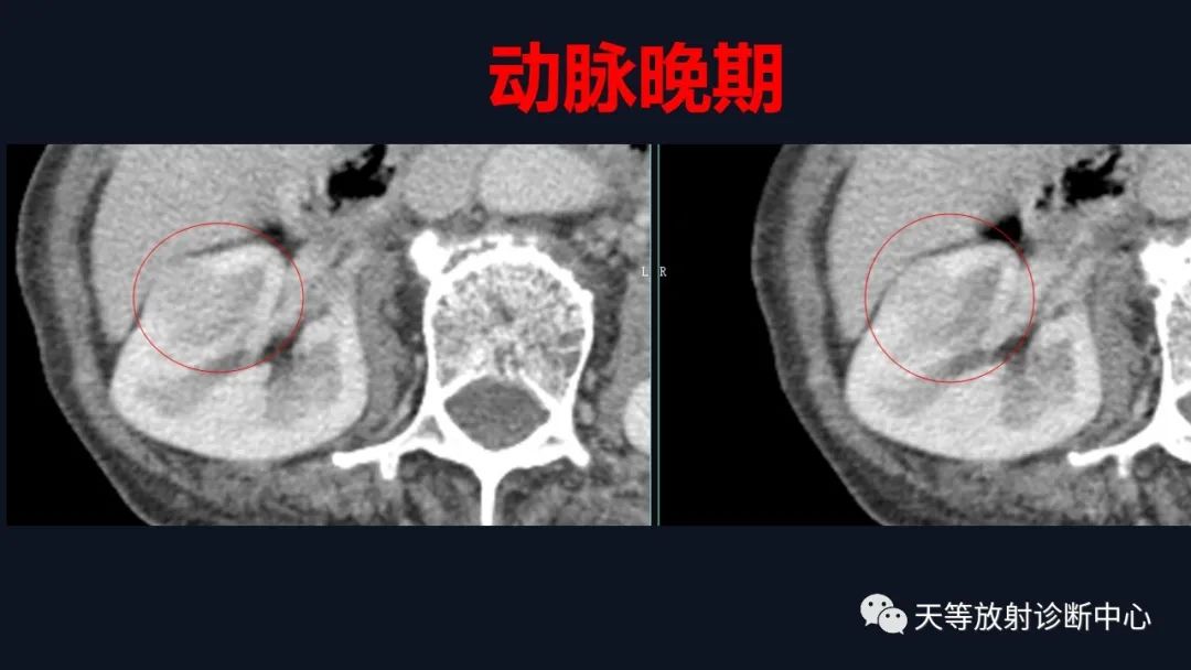 影像PPT - 【病例】肾血管平滑肌脂肪瘤1例CT影像-10 影像PPT - 【病例】肾血管平滑肌脂肪瘤1例CT影像-10