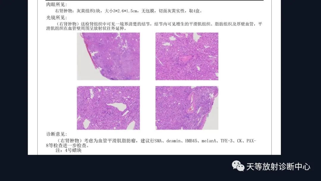 影像PPT - 【病例】肾血管平滑肌脂肪瘤1例CT影像-16 影像PPT - 【病例】肾血管平滑肌脂肪瘤1例CT影像-16
