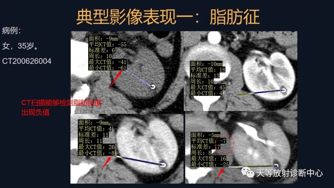 影像PPT - 【病例】肾血管平滑肌脂肪瘤1例CT影像-24 影像PPT - 【病例】肾血管平滑肌脂肪瘤1例CT影像-24