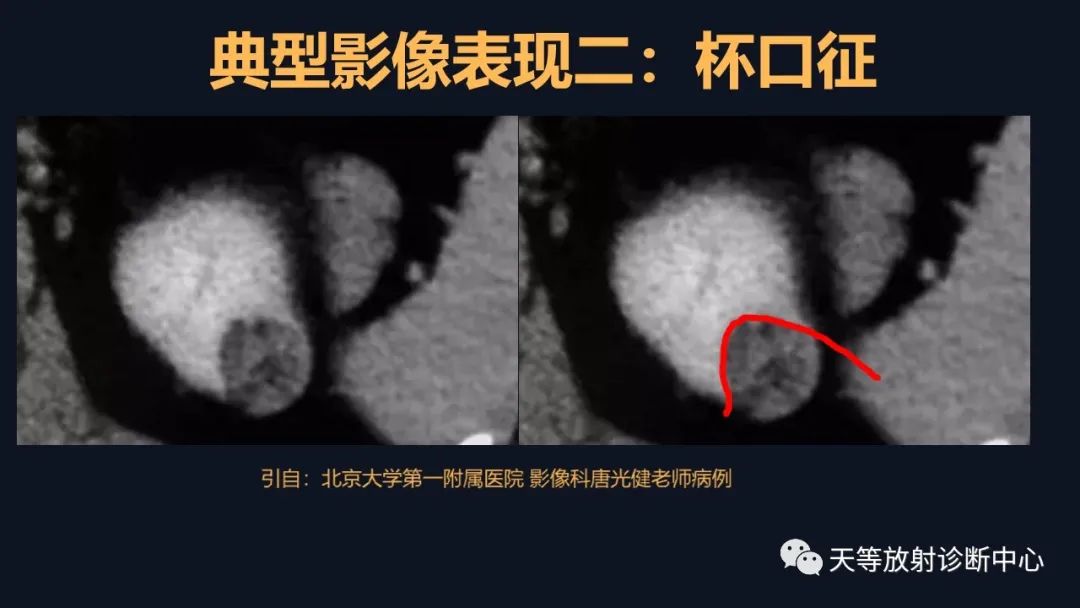影像PPT - 【病例】肾血管平滑肌脂肪瘤1例CT影像-26 影像PPT - 【病例】肾血管平滑肌脂肪瘤1例CT影像-26