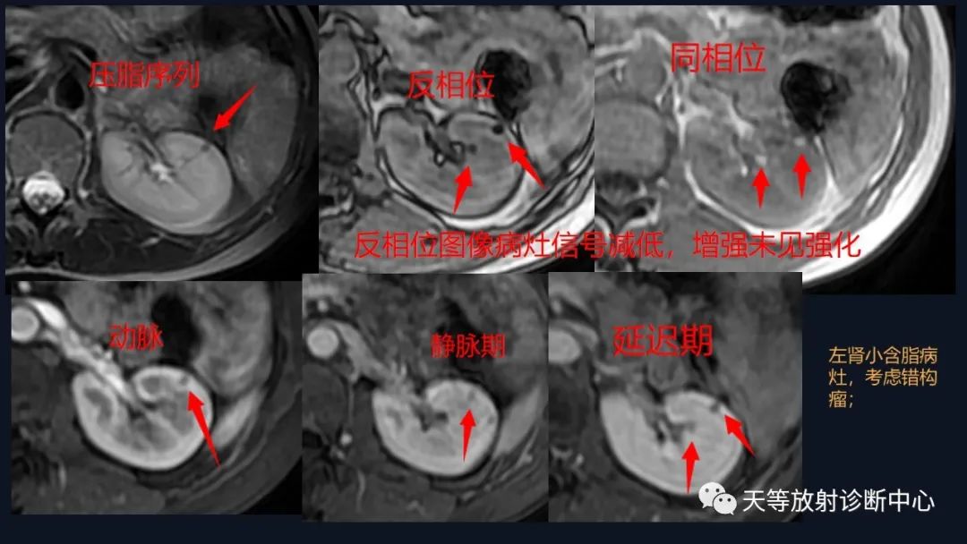 影像PPT - 【病例】肾血管平滑肌脂肪瘤1例CT影像-25 影像PPT - 【病例】肾血管平滑肌脂肪瘤1例CT影像-25